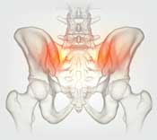 cornerlock pelvis illustration